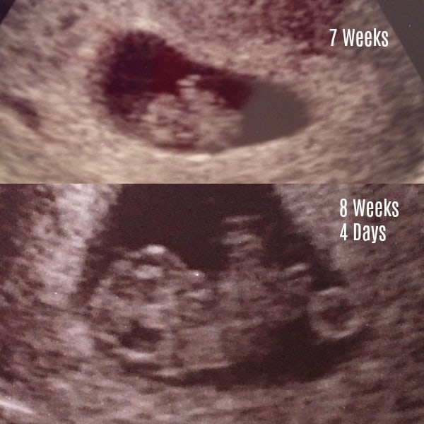 The True Story of a Wonderful First Trimester